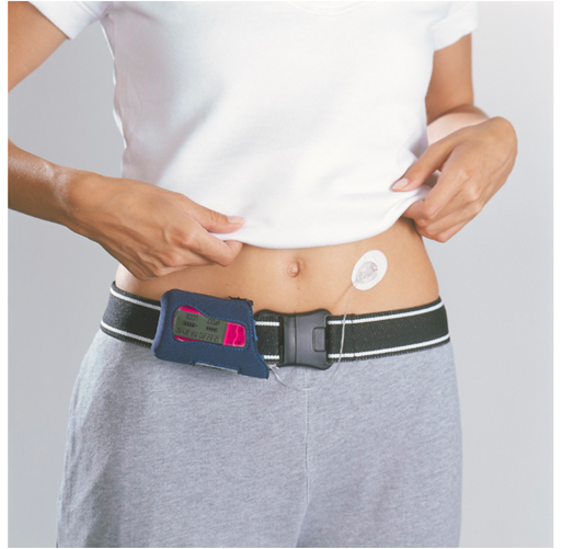 丹納IIS胰島素泵