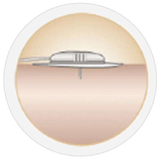 優(yōu)泵儲藥器導(dǎo)管套裝