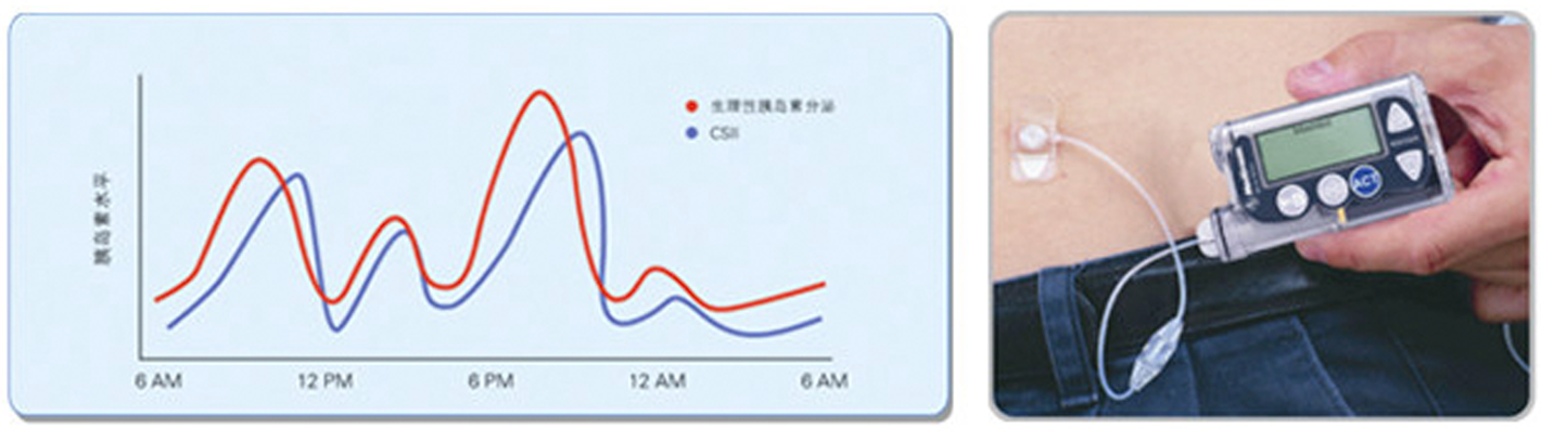 美敦力722胰島素泵