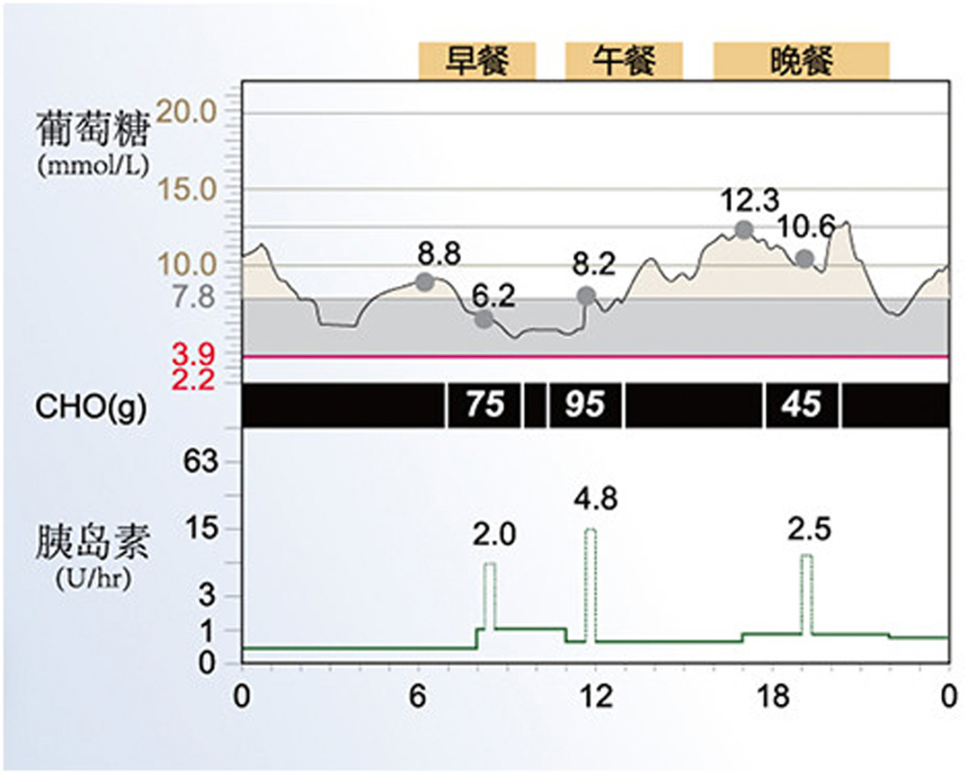 美敦力722胰島素泵